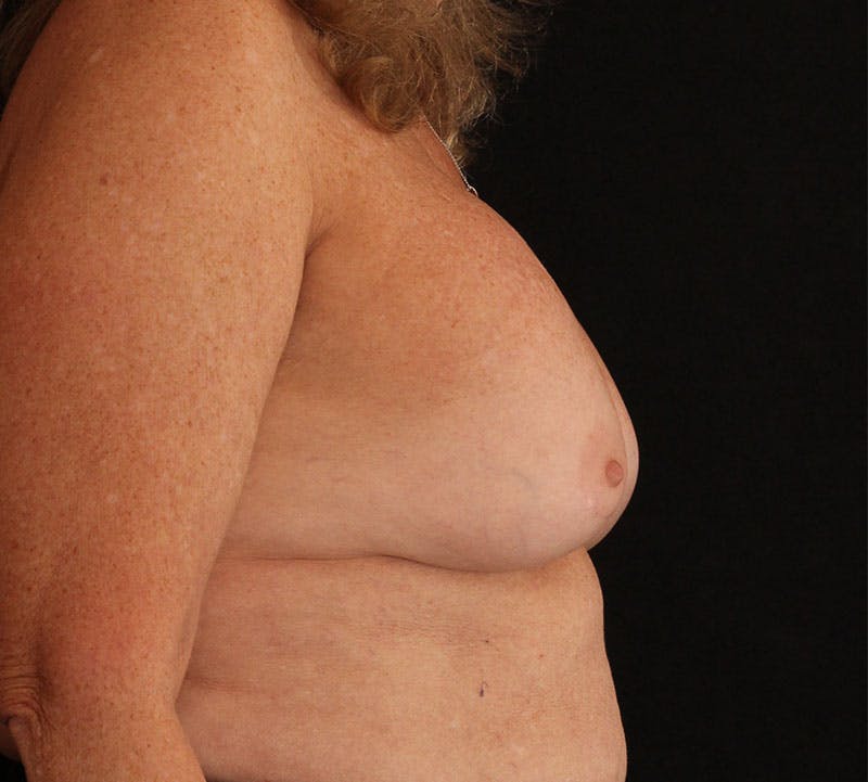 Breast Revision Before & After Gallery - Patient 100193 - Image 5