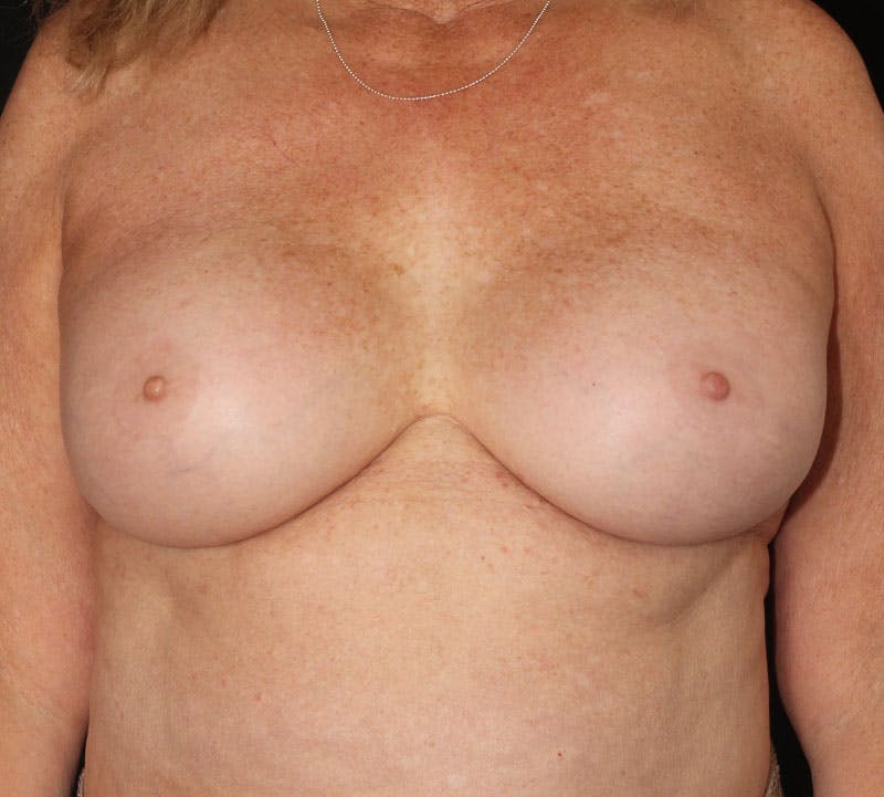 Breast Revision Before & After Gallery - Patient 100193 - Image 2