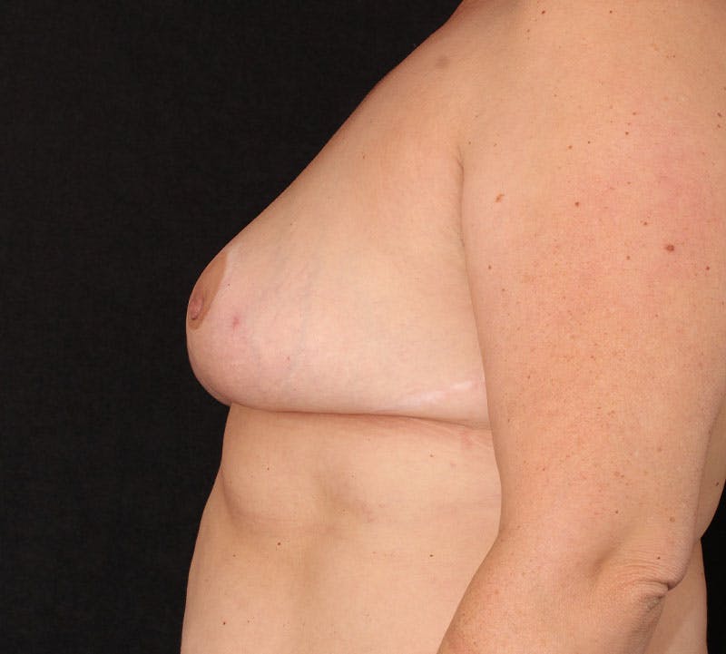 Nipple Inversion Before & After Gallery - Patient 393961 - Image 8