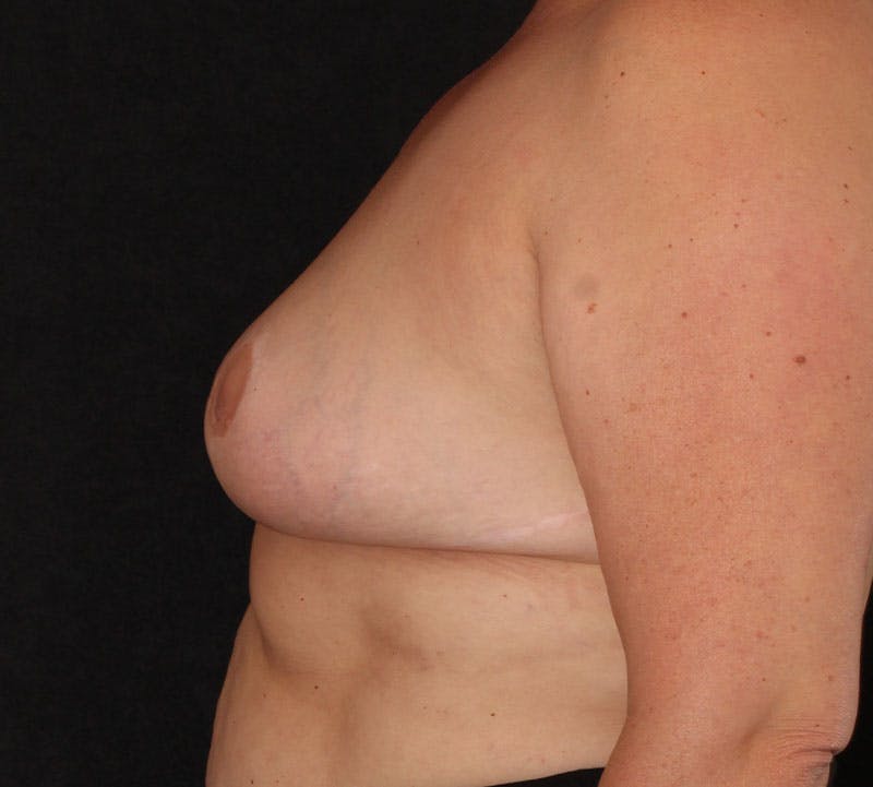 Nipple Inversion Before & After Gallery - Patient 393961 - Image 7
