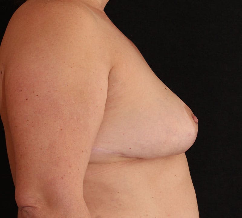 Nipple Inversion Before & After Gallery - Patient 393961 - Image 6