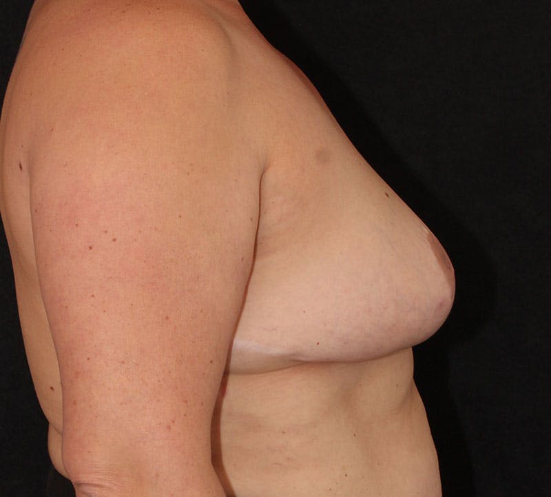 Nipple Inversion Before & After Gallery - Patient 393961 - Image 5