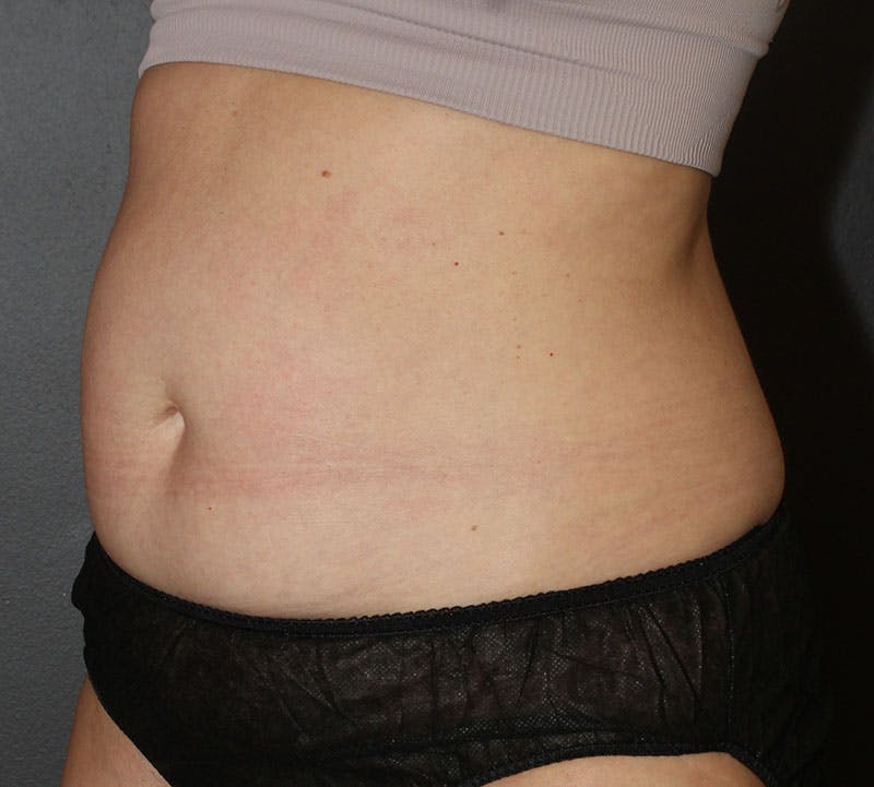 Abdominoplasty (Tummy Tuck) Before & After Gallery - Patient 304841 - Image 9