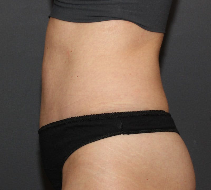 Abdominoplasty (Tummy Tuck) Before & After Gallery - Patient 304841 - Image 8