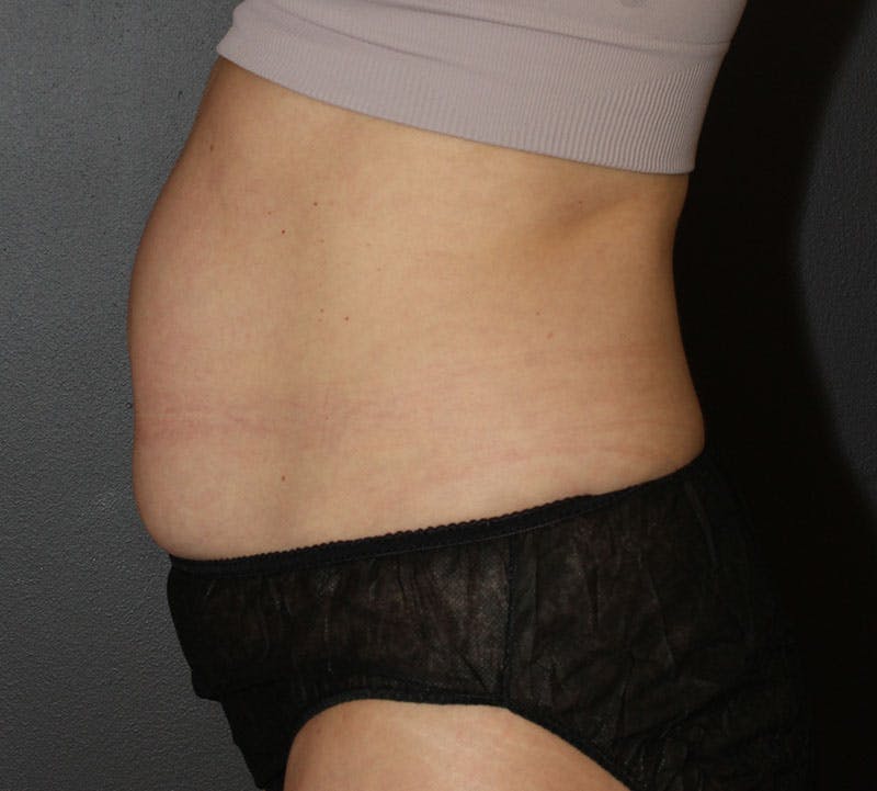 Abdominoplasty (Tummy Tuck) Before & After Gallery - Patient 304841 - Image 7