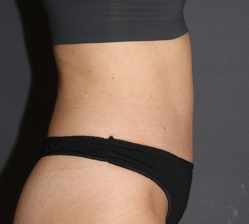 Abdominoplasty (Tummy Tuck) Before & After Gallery - Patient 304841 - Image 6