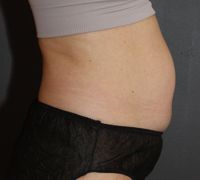 Abdominoplasty (Tummy Tuck) Before & After Gallery - Patient 304841 - Image 5