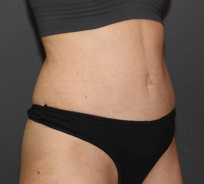 Abdominoplasty (Tummy Tuck) Before & After Gallery - Patient 304841 - Image 4
