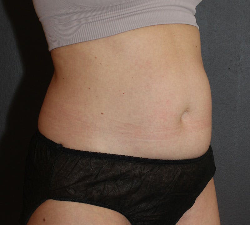 Abdominoplasty (Tummy Tuck) Before & After Gallery - Patient 304841 - Image 3