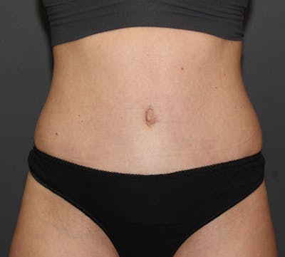 Abdominoplasty (Tummy Tuck) Before & After Gallery - Patient 304841 - Image 2
