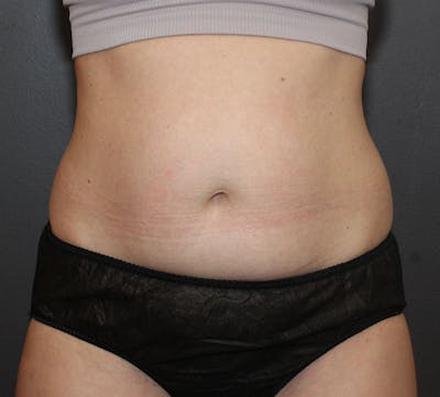 Abdominoplasty (Tummy Tuck) Before & After Gallery - Patient 304841 - Image 1