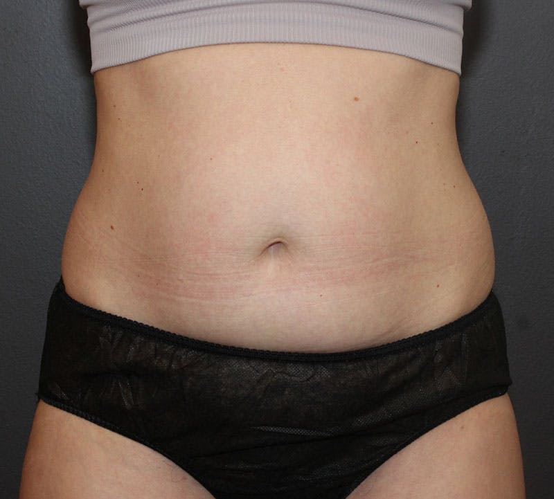 Abdominoplasty (Tummy Tuck) Before & After Gallery - Patient 304841 - Image 1