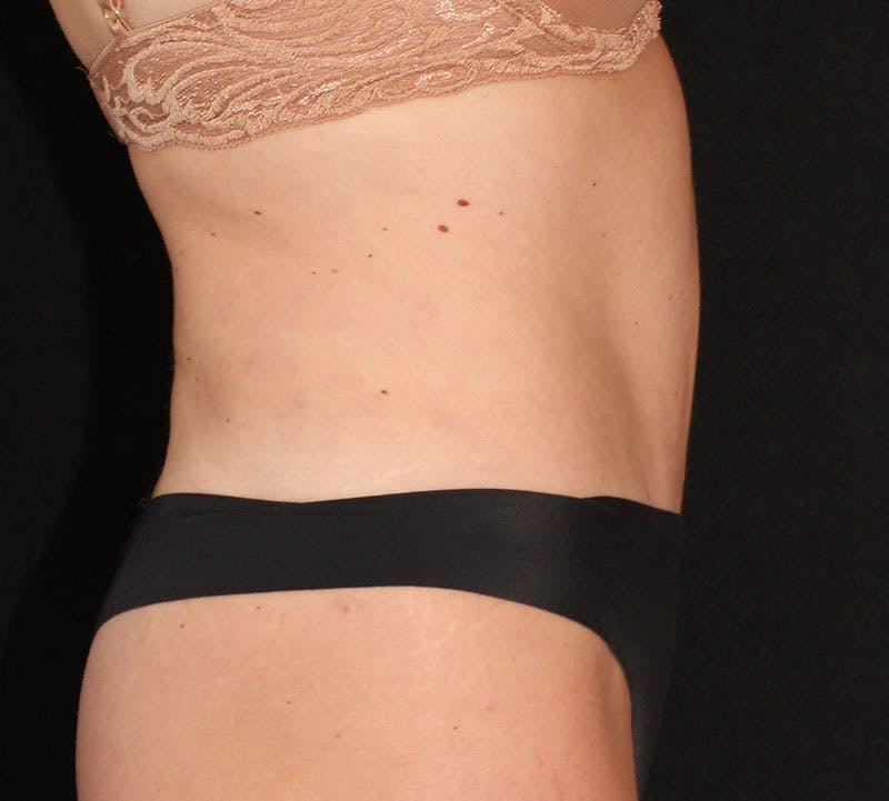 Abdominoplasty (Tummy Tuck) Before & After Gallery - Patient 198563 - Image 6