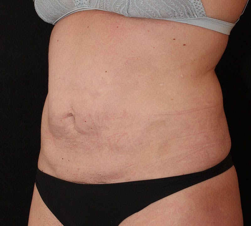 Abdominoplasty (Tummy Tuck) Before & After Gallery - Patient 198563 - Image 9