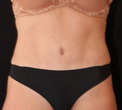 Abdominoplasty (Tummy Tuck) Before & After Gallery - Patient 198563 - Image 2