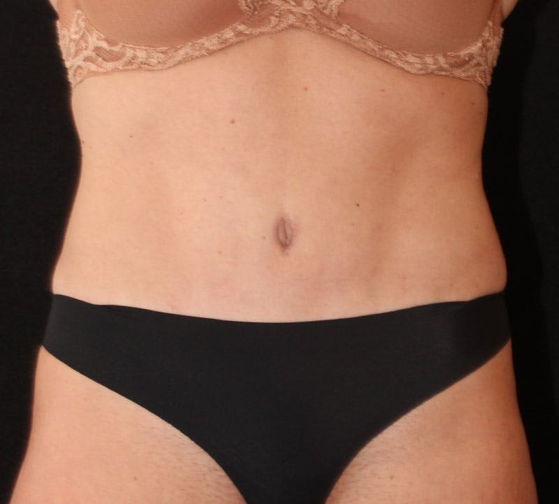 Abdominoplasty (Tummy Tuck) Before & After Gallery - Patient 198563 - Image 2