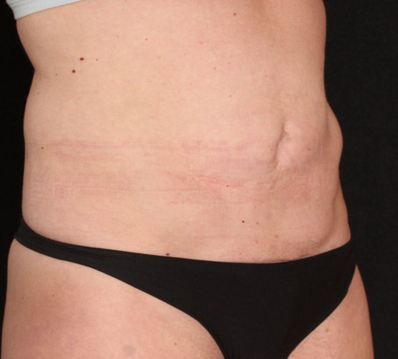 Abdominoplasty (Tummy Tuck) Before & After Gallery - Patient 198563 - Image 3