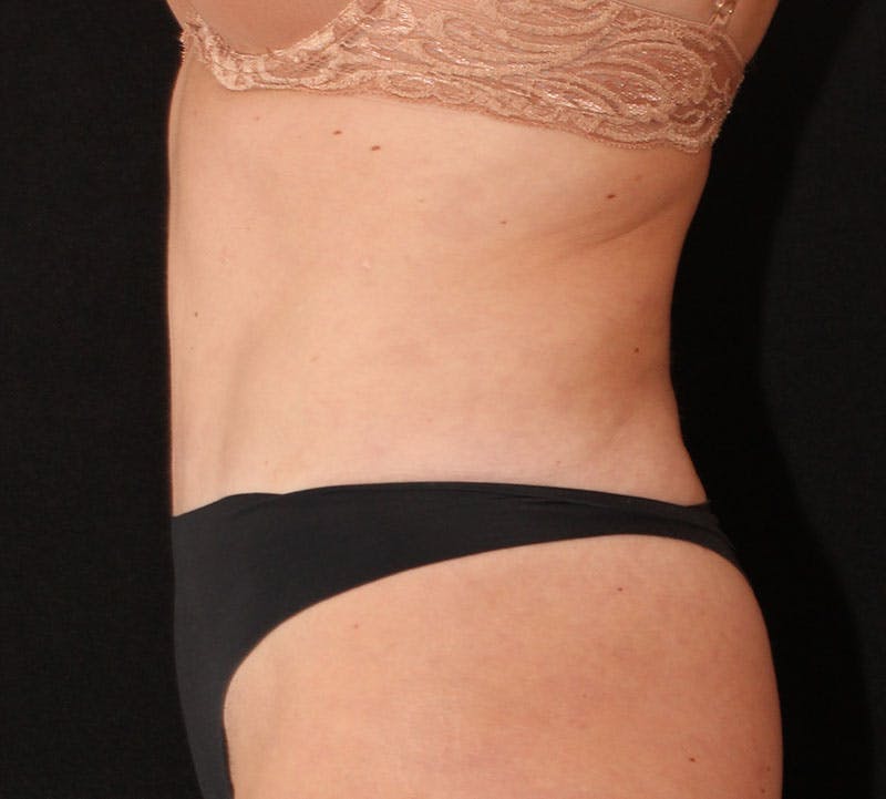 Abdominoplasty (Tummy Tuck) Before & After Gallery - Patient 198563 - Image 8