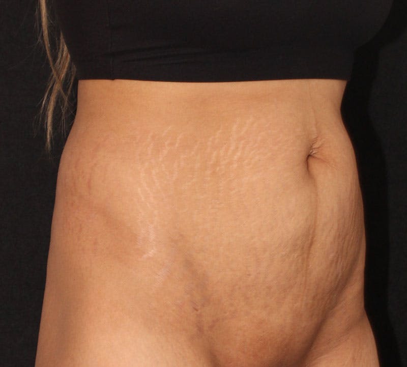Abdominoplasty (Tummy Tuck) Before & After Gallery - Patient 648578 - Image 3