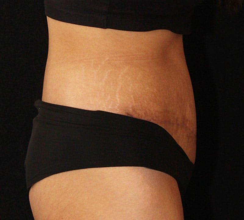 Abdominoplasty (Tummy Tuck) Before & After Gallery - Patient 648578 - Image 6