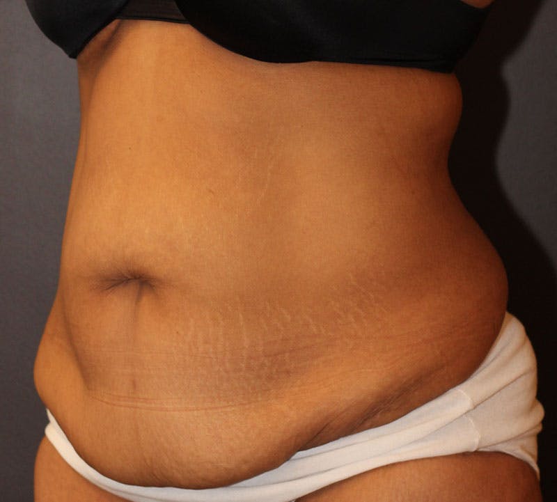 Abdominoplasty (Tummy Tuck) Before & After Gallery - Patient 389386 - Image 9