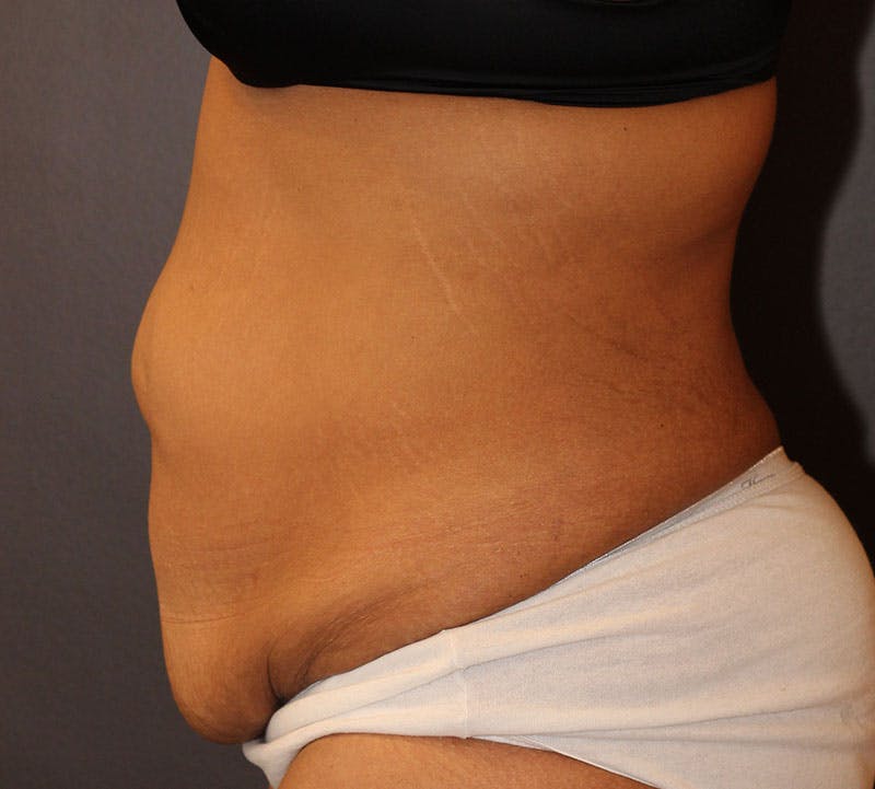 Abdominoplasty (Tummy Tuck) Before & After Gallery - Patient 389386 - Image 7