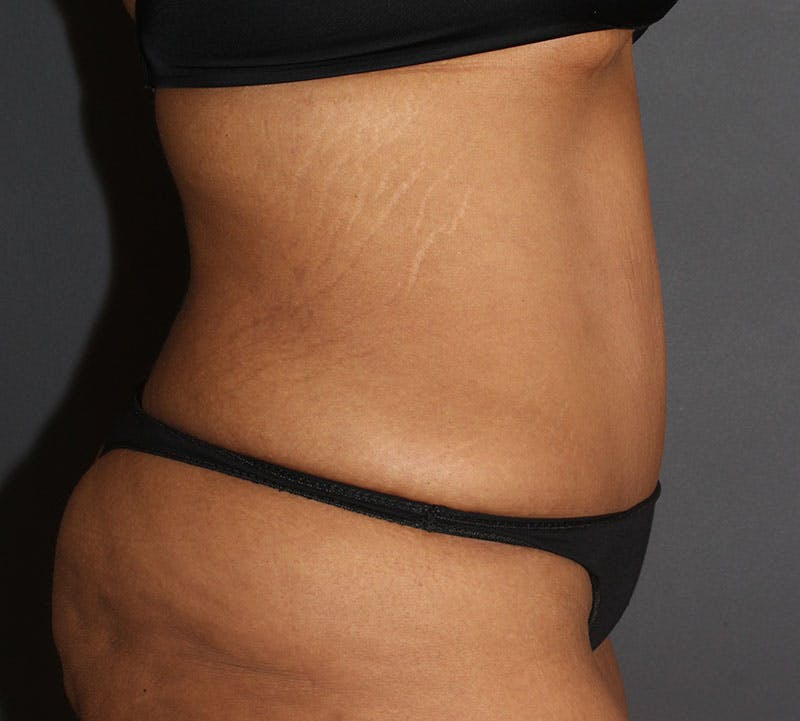 Abdominoplasty (Tummy Tuck) Before & After Gallery - Patient 389386 - Image 6