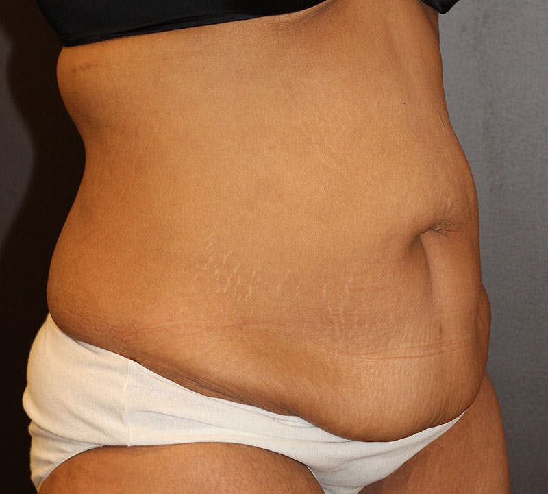 Abdominoplasty (Tummy Tuck) Before & After Gallery - Patient 389386 - Image 3