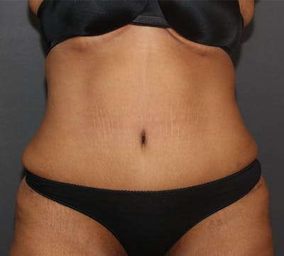 Abdominoplasty (Tummy Tuck) Before & After Gallery - Patient 389386 - Image 2