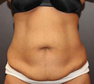 Abdominoplasty (Tummy Tuck) Before & After Gallery - Patient 389386 - Image 1