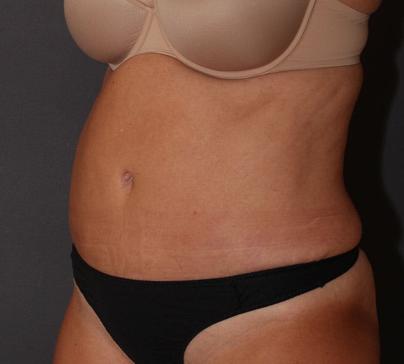 Abdominoplasty (Tummy Tuck) Before & After Gallery - Patient 281067 - Image 10
