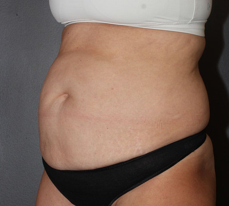 Abdominoplasty (Tummy Tuck) Before & After Gallery - Patient 281067 - Image 9