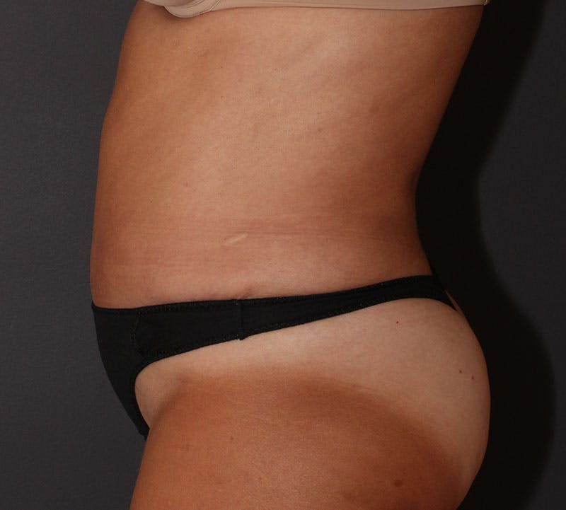 Abdominoplasty (Tummy Tuck) Before & After Gallery - Patient 281067 - Image 8