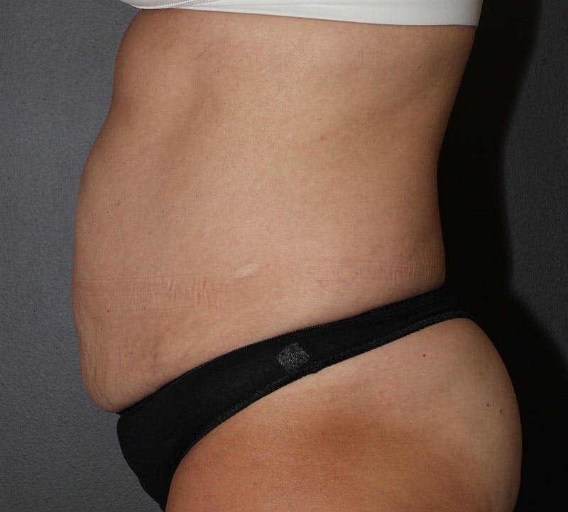 Abdominoplasty (Tummy Tuck) Before & After Gallery - Patient 281067 - Image 7