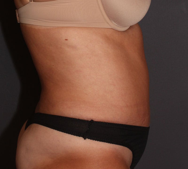 Abdominoplasty (Tummy Tuck) Before & After Gallery - Patient 281067 - Image 6