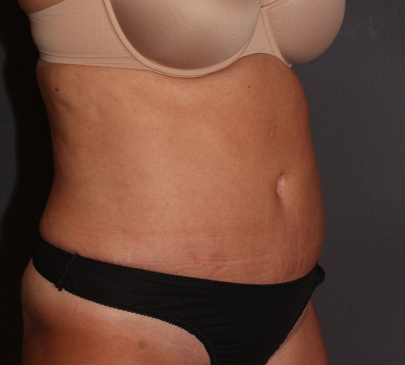 Abdominoplasty (Tummy Tuck) Before & After Gallery - Patient 281067 - Image 4