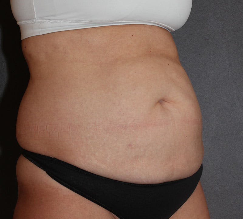 Abdominoplasty (Tummy Tuck) Before & After Gallery - Patient 281067 - Image 3