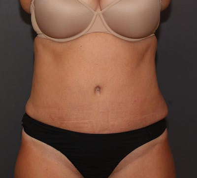 Abdominoplasty (Tummy Tuck) Before & After Gallery - Patient 281067 - Image 2