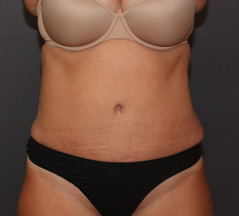 Abdominoplasty (Tummy Tuck) Before & After Gallery - Patient 281067 - Image 2
