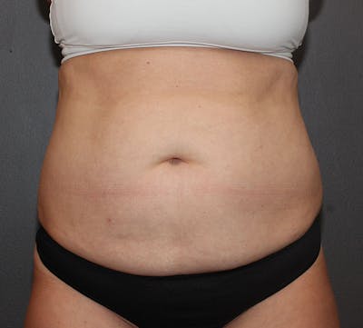 Abdominoplasty (Tummy Tuck) Before & After Gallery - Patient 281067 - Image 1