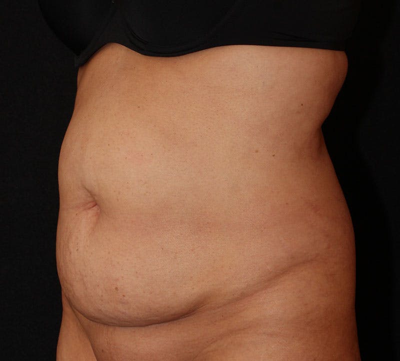 Abdominoplasty (Tummy Tuck) Before & After Gallery - Patient 393767 - Image 9