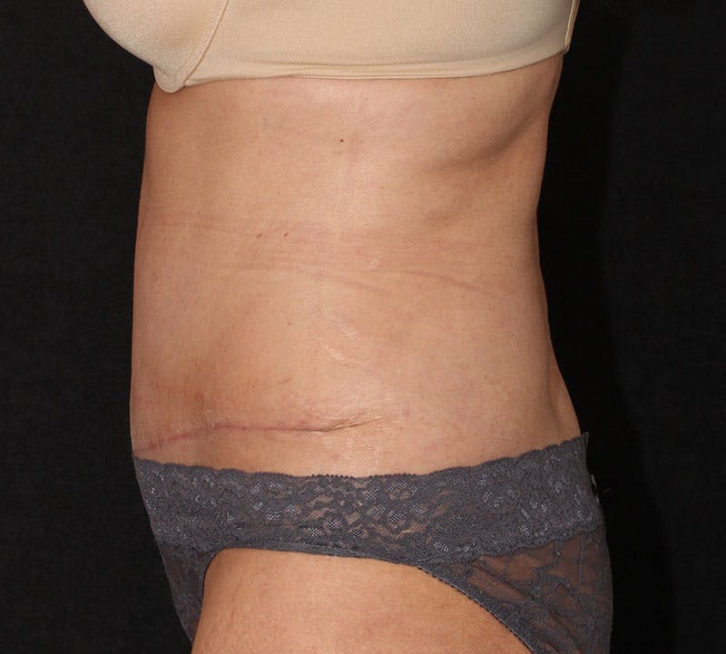 Abdominoplasty (Tummy Tuck) Before & After Gallery - Patient 393767 - Image 8