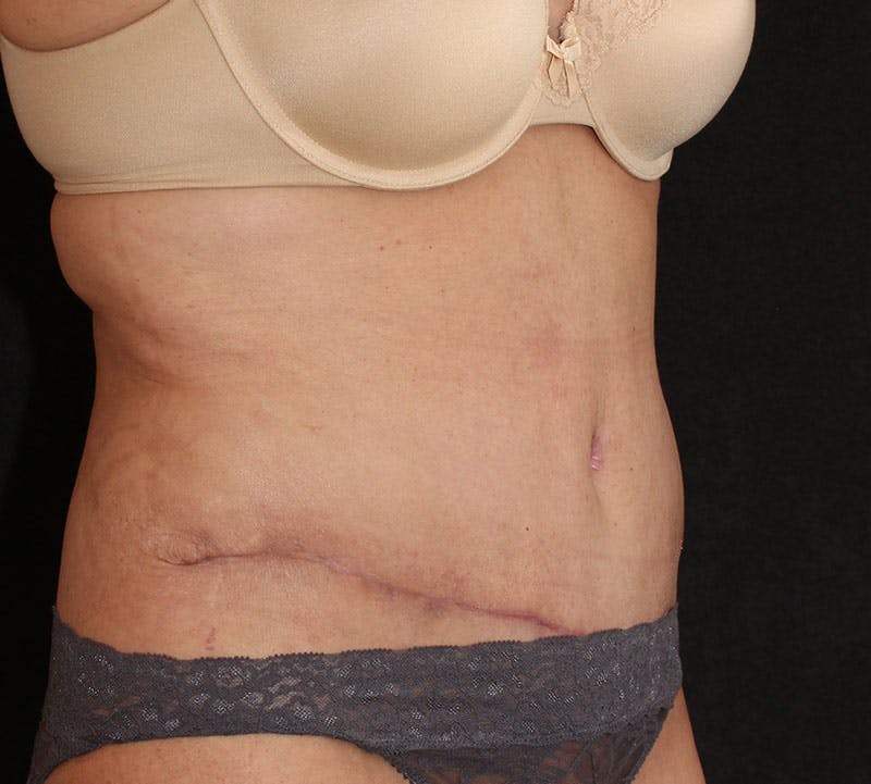 Abdominoplasty (Tummy Tuck) Before & After Gallery - Patient 393767 - Image 4