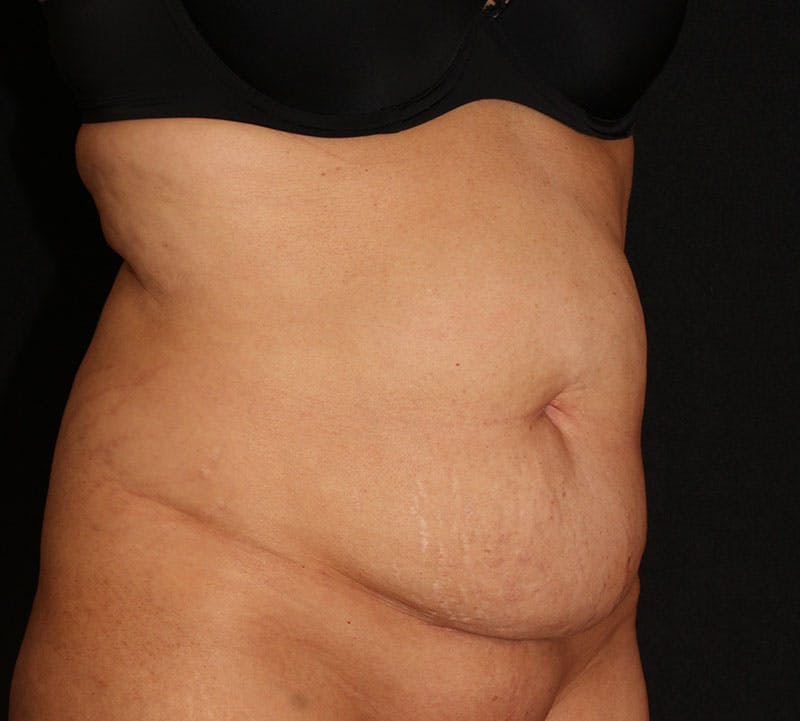 Abdominoplasty (Tummy Tuck) Before & After Gallery - Patient 393767 - Image 3