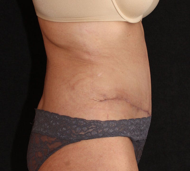 Abdominoplasty (Tummy Tuck) Before & After Gallery - Patient 393767 - Image 6