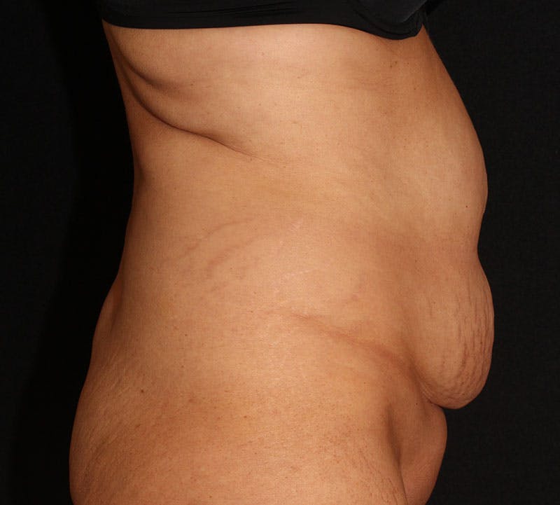 Abdominoplasty (Tummy Tuck) Before & After Gallery - Patient 393767 - Image 5