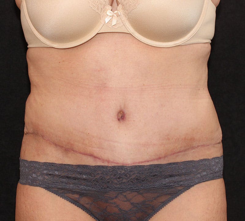 Abdominoplasty (Tummy Tuck) Before & After Gallery - Patient 393767 - Image 2