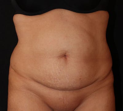 Abdominoplasty (Tummy Tuck) Before & After Gallery - Patient 393767 - Image 1