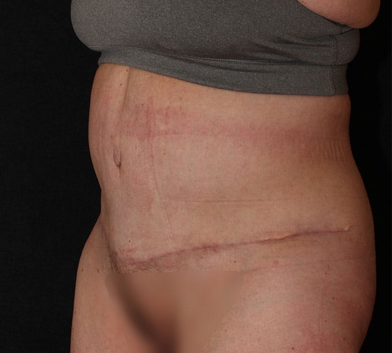 Abdominoplasty (Tummy Tuck) Before & After Gallery - Patient 113323 - Image 10