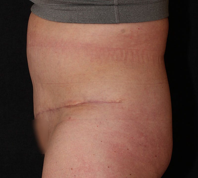 Abdominoplasty (Tummy Tuck) Before & After Gallery - Patient 113323 - Image 8